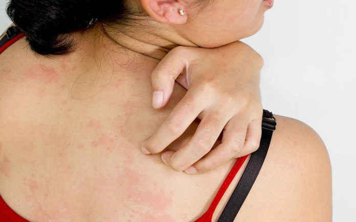 how-to-know-your-dry-irritated-skin-is-actually-eczema-page-2-of-5